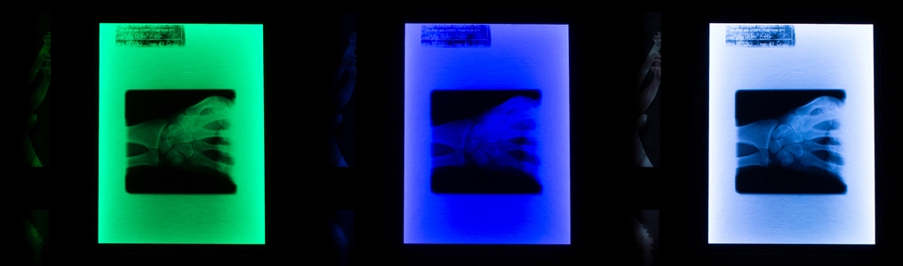 Edward Van Halen 1982 Framed & Lighted Fractured Wrist X-Ray Display